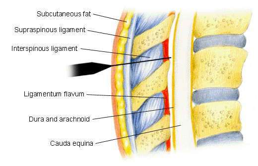 What is the difference between a spinal tap and an epidural?