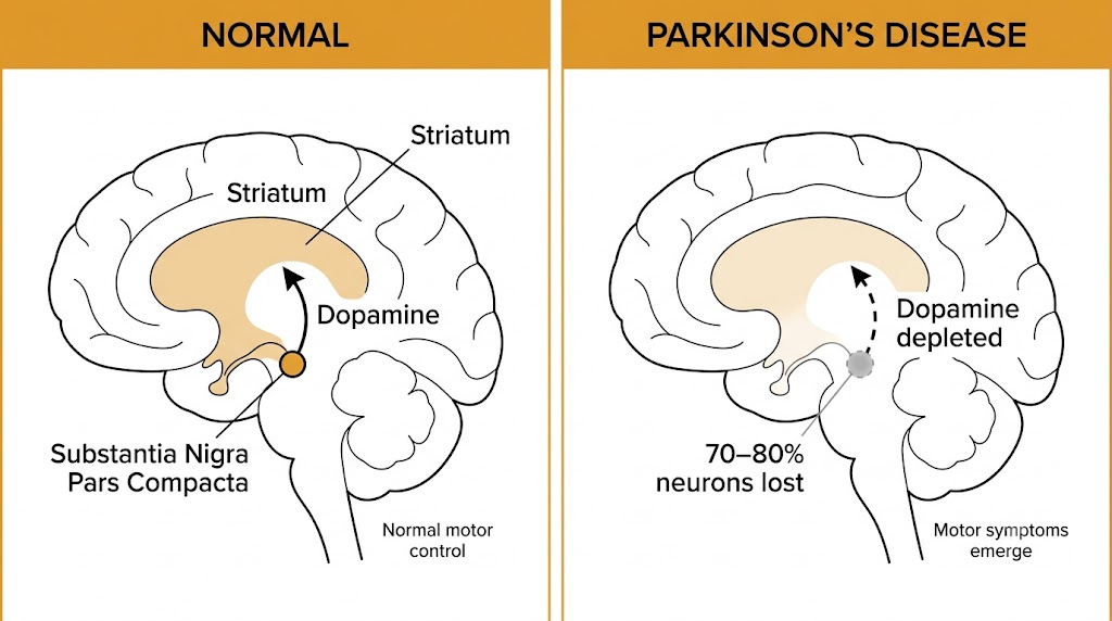 Two-panel diagram showing the nigrostriatal dopamine pathway in normal brain and in Parkinson's disease, with substantia nigra pars compacta projecting to the striatum via a solid arrow in the normal panel and a dashed arrow indicating dopamine depletion in the Parkinson's disease panel.